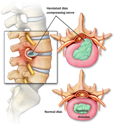 mcdc7_herniated_disk